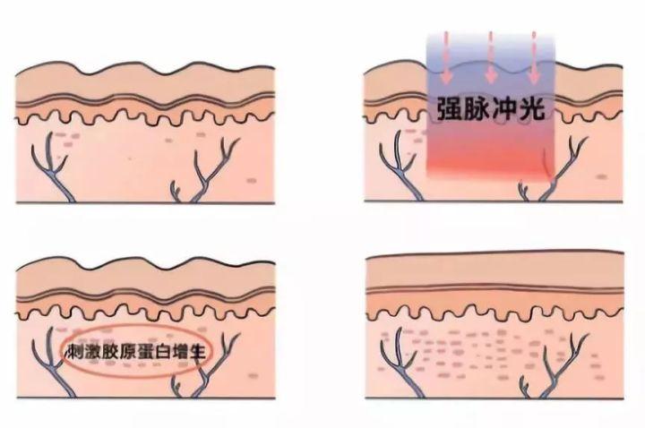 簡(jiǎn)單有效的痘坑修復(fù)方法，讓你的肌膚重拾光彩，簡(jiǎn)單有效的痘坑修復(fù)秘訣，重塑肌膚光彩！