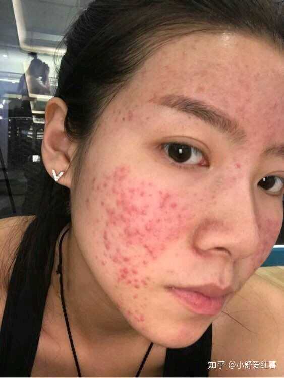 如何有效去除臉上的痘印——全方位指南，全方位指南，如何有效去除臉上痘印的方法