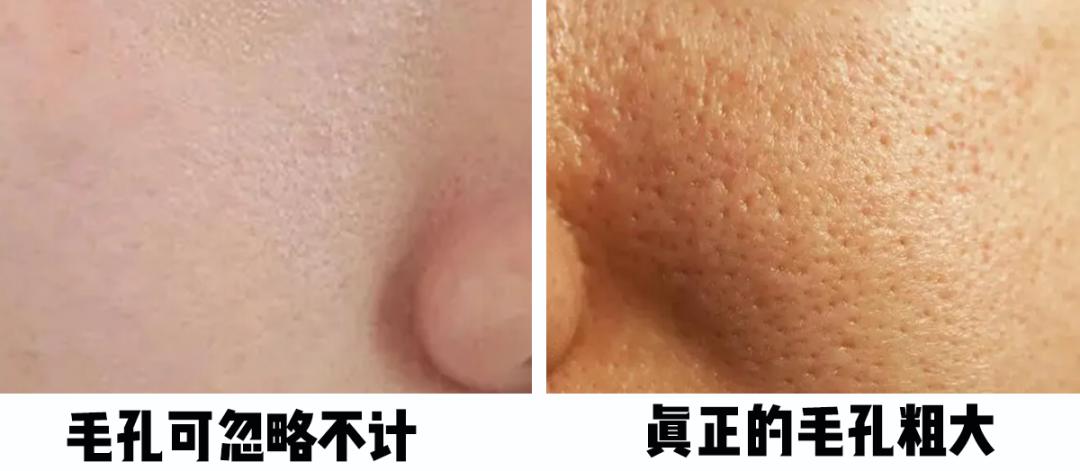 怎樣毛孔可以慢慢縮小，護膚秘籍與實用建議，護膚秘籍，縮小毛孔實用建議與指南