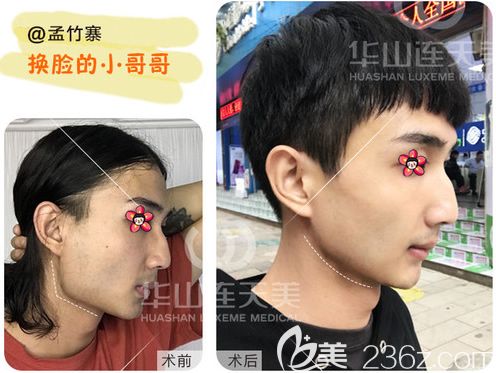 削顴骨手術(shù)費用詳解，手術(shù)費用大概要多少錢？，削顴骨手術(shù)費用詳解，手術(shù)費用及預(yù)算指南