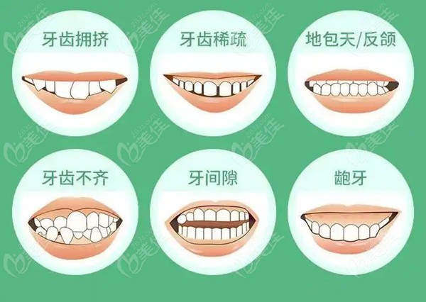 牙齒正畸費(fèi)用詳解，一般多少？，牙齒正畸費(fèi)用全面解析，了解一般價(jià)格及影響因素