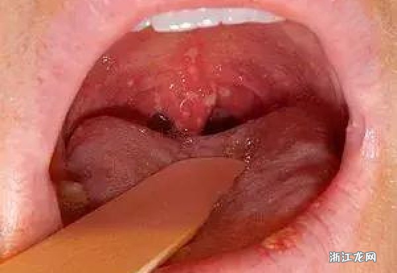 皰疹性咽峽炎五個分期詳解，皰疹性咽峽炎的五個分期詳解及特點(diǎn)解析