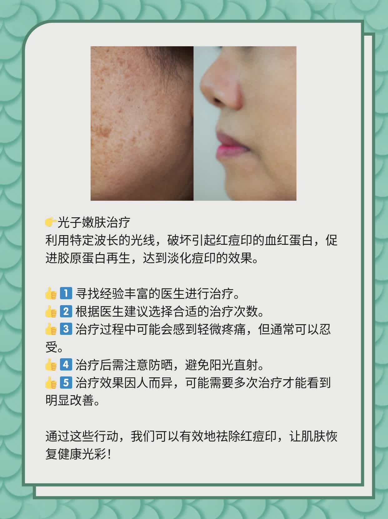 如何有效去除紅痘印，一站式解決方案，一站式解決紅痘印問題，有效去除方法大全