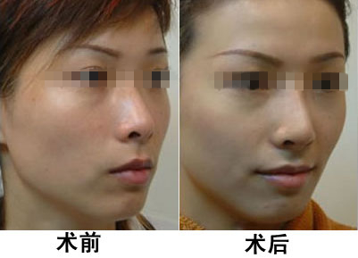 光子嫩膚做一次有效嗎？深入了解光子嫩膚的效果與過程，光子嫩膚效果與過程解析，做一次是否有效？