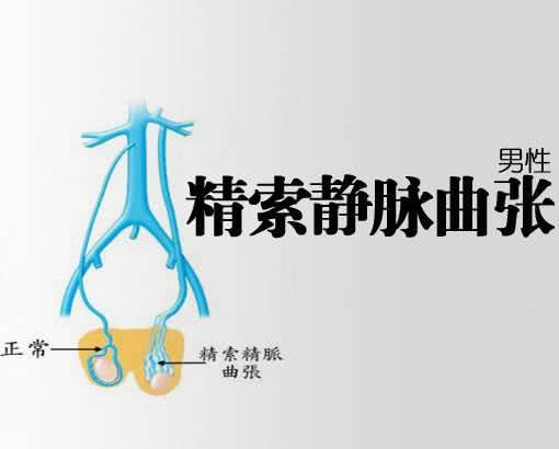 精索靜脈曲張的癥狀表現(xiàn)及其影響，精索靜脈曲張的癥狀表現(xiàn)及其潛在影響