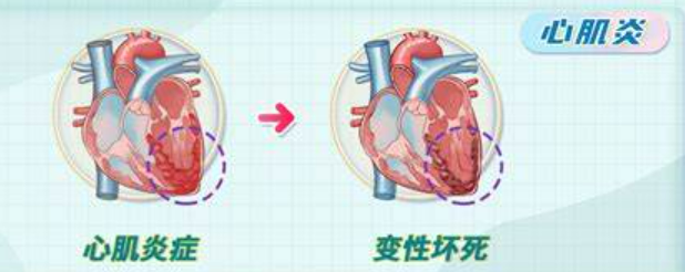 女性心肌炎的癥狀表現(xiàn)及其重要性，了解、預防與治療，女性心肌炎的癥狀、重要性，了解、預防與治療全攻略