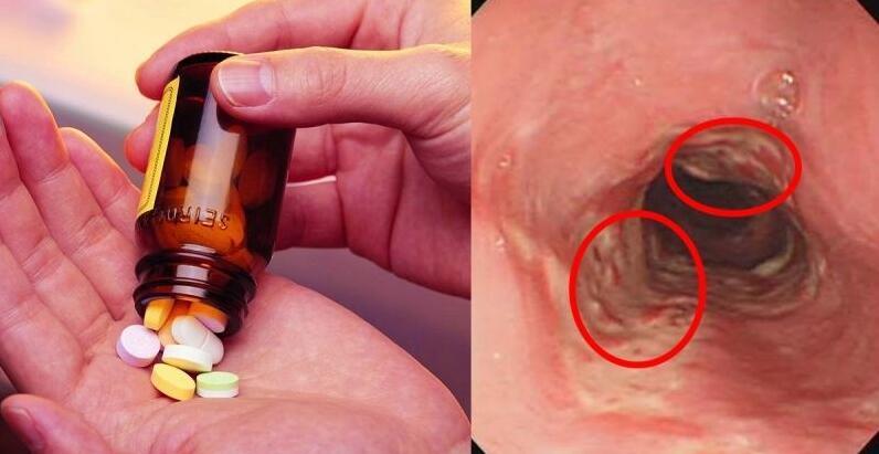 食道炎與食道癌，最明顯的區(qū)別解析，食道炎與食道癌，顯著區(qū)別解析