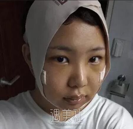 磨骨一年后的驚人變化，對比照片揭示細(xì)節(jié)，磨骨一年后的驚人變化，細(xì)節(jié)對比揭示驚人效果