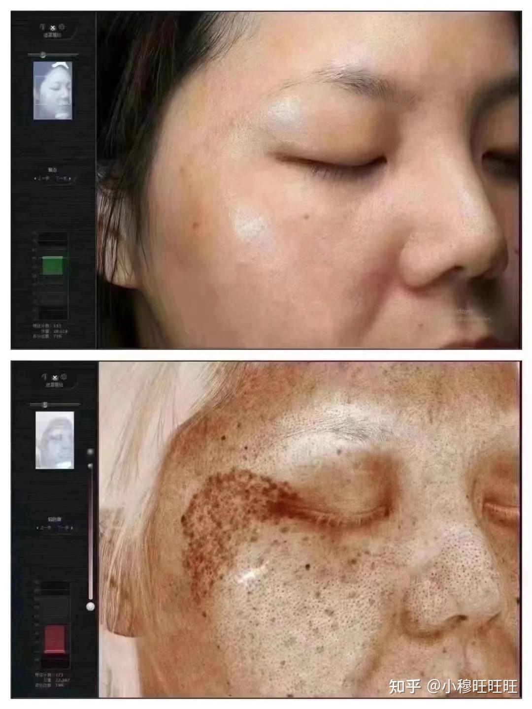 激光祛斑，選擇醫(yī)院還是美容院？全面解讀助您做出明智決策，激光祛斑，如何選擇醫(yī)院與美容院？全面解讀為您指明決策方向