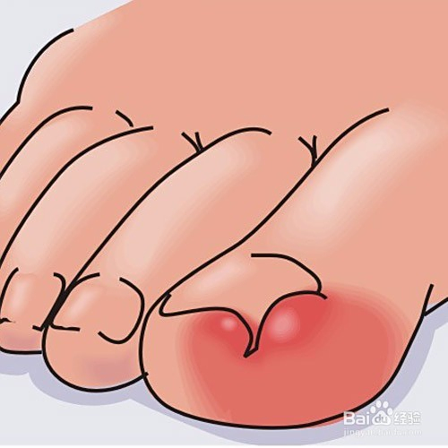 如何應對腳趾甲長到肉里的問題——全方位解決方案，全方位解決方案，應對腳趾甲長到肉里的困擾與挑戰(zhàn)