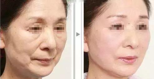 全面解析痤瘡皮膚，成因、治療與護(hù)理，全面解析痤瘡皮膚，成因、治療與護(hù)理指南