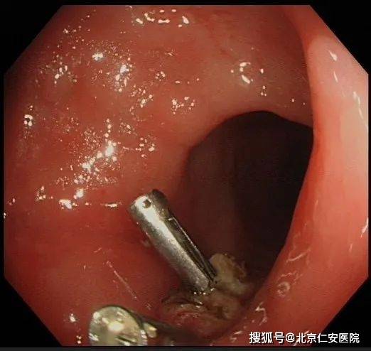 胃腸鏡檢查后悔死了？了解真相，消除疑慮，揭秘胃腸鏡檢查真相，消除疑慮，避免后悔！