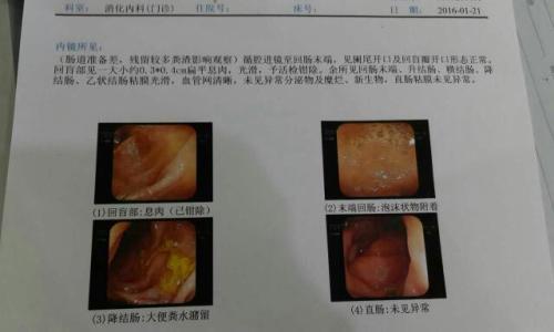 如何判斷痔瘡還是息肉，癥狀、診斷與治療方法，痔瘡與息肉，癥狀、診斷及治療方法詳解
