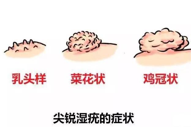 尖銳濕疣與艾滋病，并非必然的前兆關(guān)聯(lián)，尖銳濕疣與艾滋病，非必然前兆關(guān)聯(lián)探討