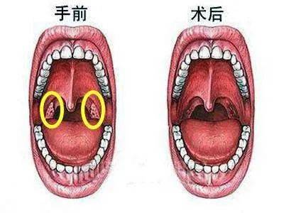 如何應對扁桃體發(fā)炎引起的喉嚨腫痛？，如何應對扁桃體炎引起的喉嚨腫痛？有效緩解方法與建議。