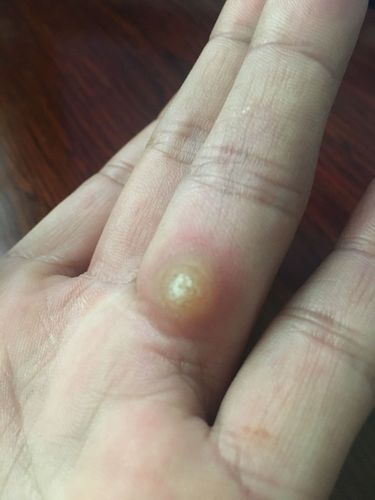 手上長(zhǎng)雞眼初期圖片，了解、預(yù)防與治療，手上長(zhǎng)雞眼，初期圖片、預(yù)防與治療方法全解析