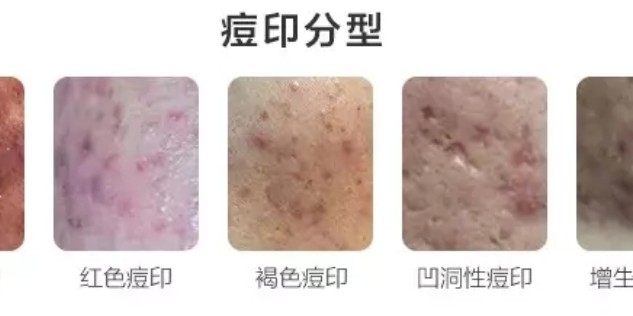 怎樣去痘印效果最好的方法，揭秘最佳去痘印方法，告別臉部瑕疵！