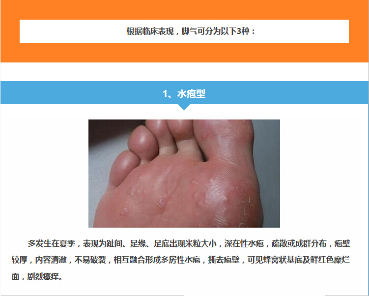 水泡型腳氣怎么治能除根——全面解析最佳治療方案，水泡型腳氣根治攻略，全面解析最佳治療方案