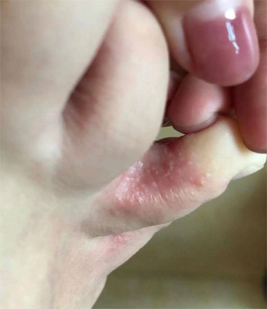 腳氣爛腳趾縫癢潰爛的治療方法，全面解析與有效策略，腳氣爛腳趾縫癢潰爛全面解析與治療方法探討