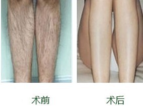 激光脫毛，價格因素詳解，激光脫毛詳解，價格因素剖析