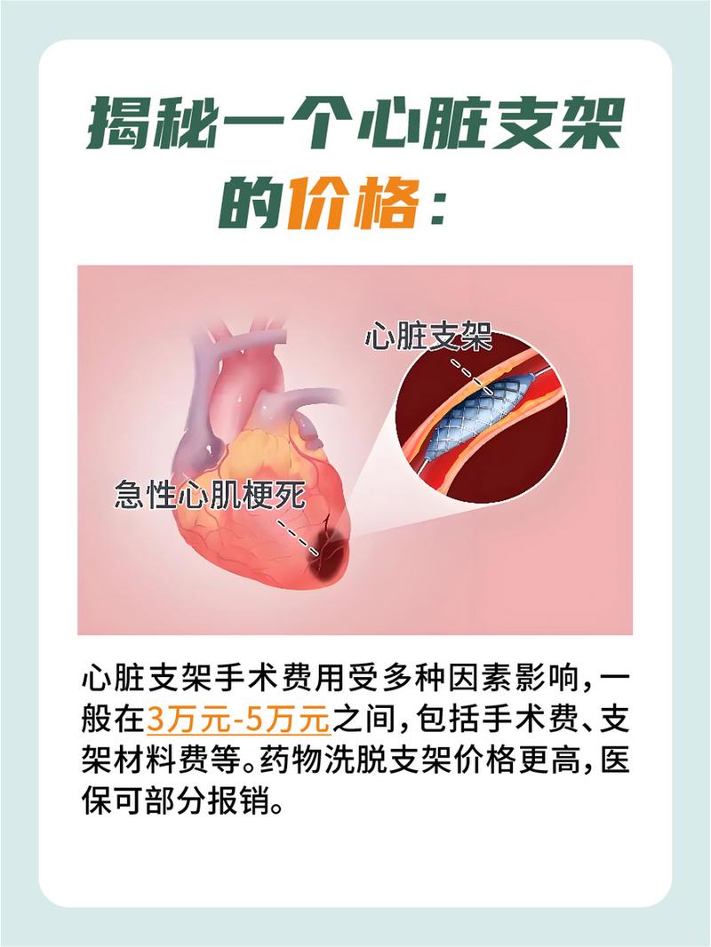 關(guān)于血管支架的價(jià)格，你需要知道的一切，血管支架價(jià)格全解析，你需要了解的一切