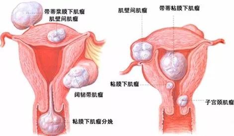 正常宮頸口的照片，了解、識別與關(guān)注女性健康，女性健康知識普及，正常宮頸口照片，識別與關(guān)注宮頸健康