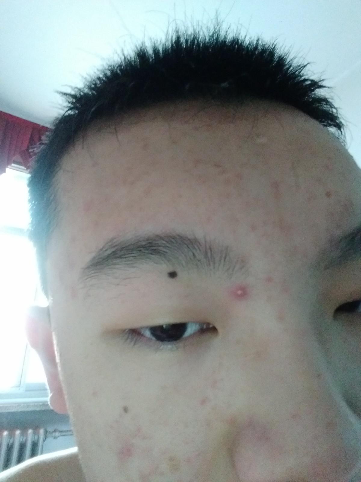 臉上痘痘太多了怎么辦？全方位護膚指南助你擺脫困擾，全方位護膚指南，解決臉部痘痘困擾，重拾肌膚光彩
