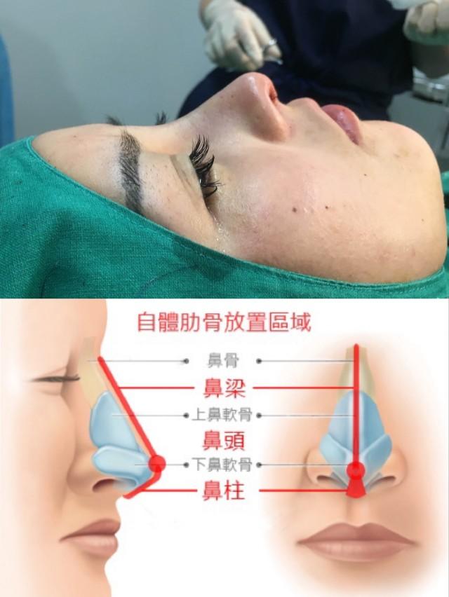 鼻綜合整形項(xiàng)目詳解，包括哪些項(xiàng)目？，鼻綜合整形項(xiàng)目詳解，涵蓋內(nèi)容與整形項(xiàng)目概覽