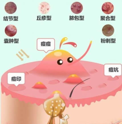 痤瘡忌口食物清單，戰(zhàn)勝痘痘，從飲食開始，戰(zhàn)勝痘痘，痤瘡忌口食物清單助你調(diào)整飲食，遠(yuǎn)離皮膚困擾