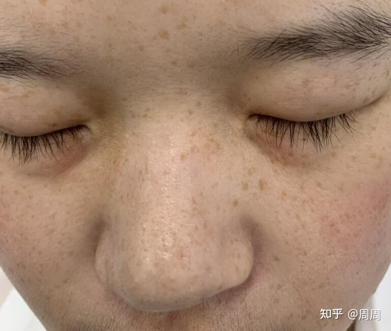 如何淡化雀斑最有效，綜合方法與日常護(hù)理，如何有效淡化雀斑，綜合方法與日常護(hù)理全解析