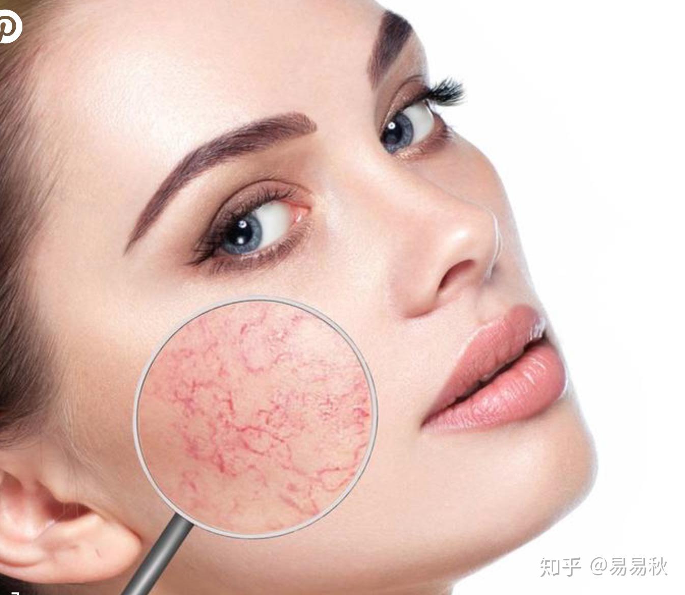 改善面部紅血絲的方法，改善面部紅血絲的有效方法