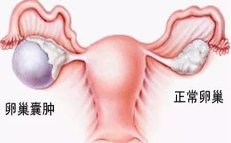 卵巢囊腫的十個(gè)征兆，卵巢囊腫的十個(gè)征兆解析