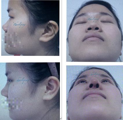 鼻頭縮小整形價格詳解，因素、費(fèi)用及注意事項，鼻頭縮小整形價格解析，費(fèi)用、因素與注意事項全指南