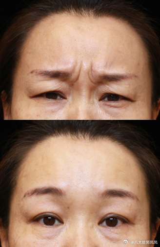 川字紋消除小偏方——讓你輕松告別皺紋困擾，川字紋消除偏方，告別皺紋，輕松展現(xiàn)年輕光彩！