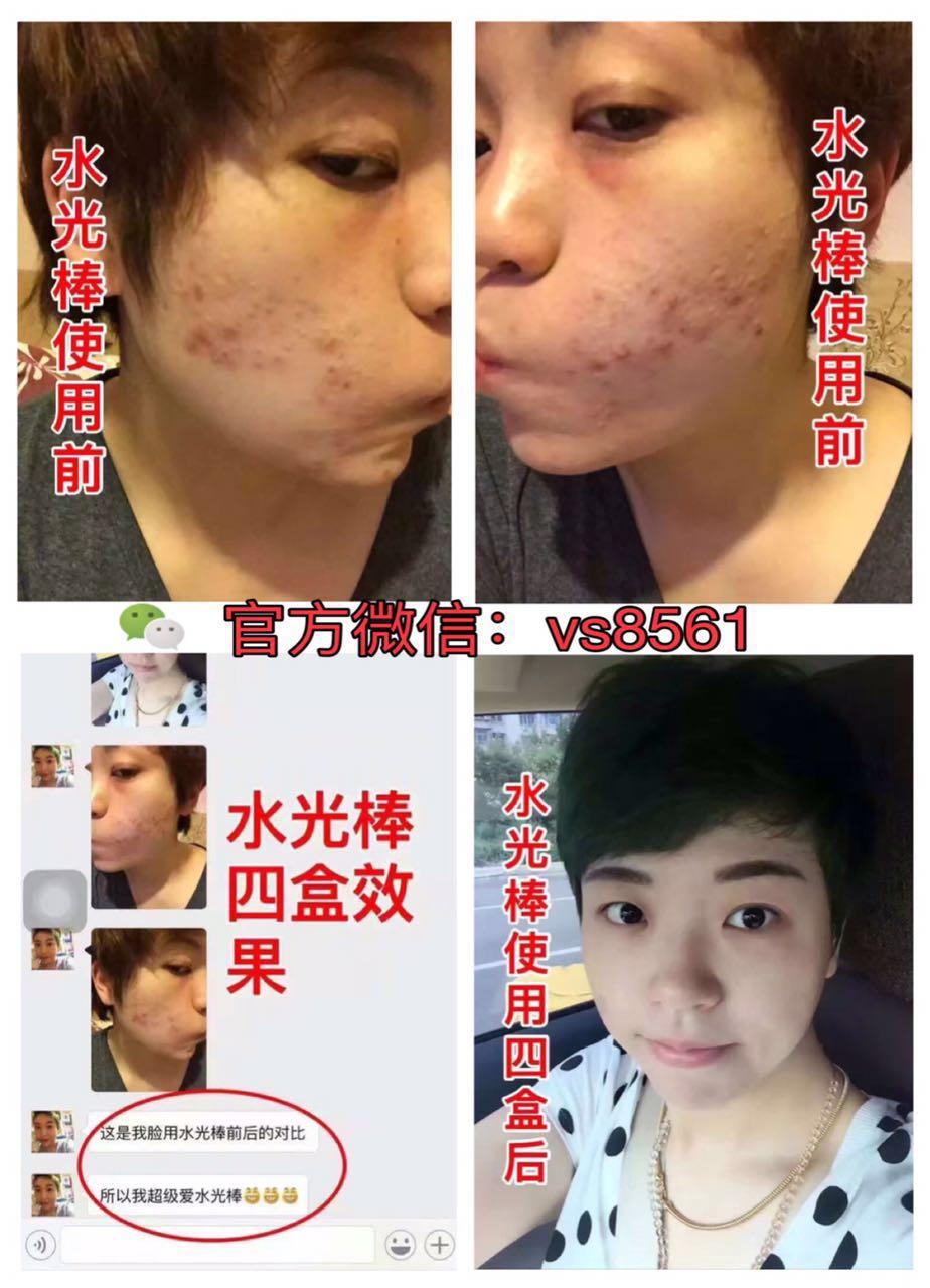 去除青春痘最有效的方法，全面解析最佳方案，全面解析，最有效的青春痘去除方案