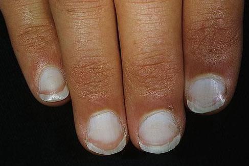 肝不好指甲圖片，揭示指甲變化與肝臟健康的關(guān)系，指甲變化揭示肝臟健康，圖片解析指甲與肝臟的聯(lián)系