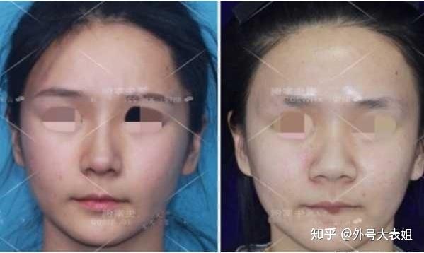 鼻翼縮小術(shù)對比照片，了解效果與變化，鼻翼縮小術(shù)對比照片，效果與變化的直觀展示