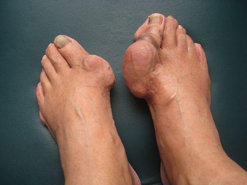 尿酸高最快的恢復(fù)方法，全面解析與行動(dòng)指南，尿酸高患者必看，全面解析與行動(dòng)指南，快速恢復(fù)健康之道