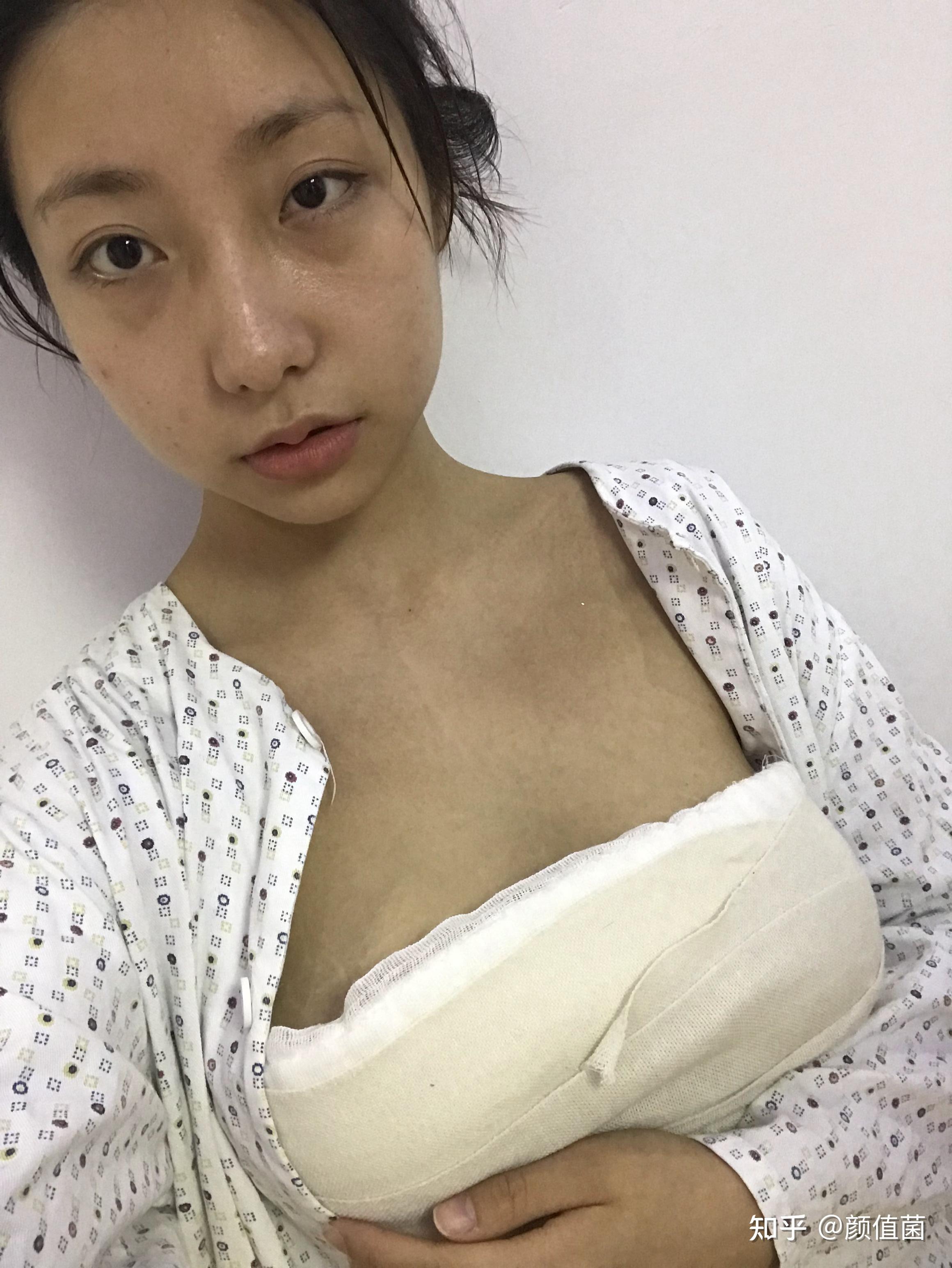 自體脂肪隆胸的真實(shí)經(jīng)歷分享，自體脂肪隆胸的真實(shí)體驗(yàn)分享