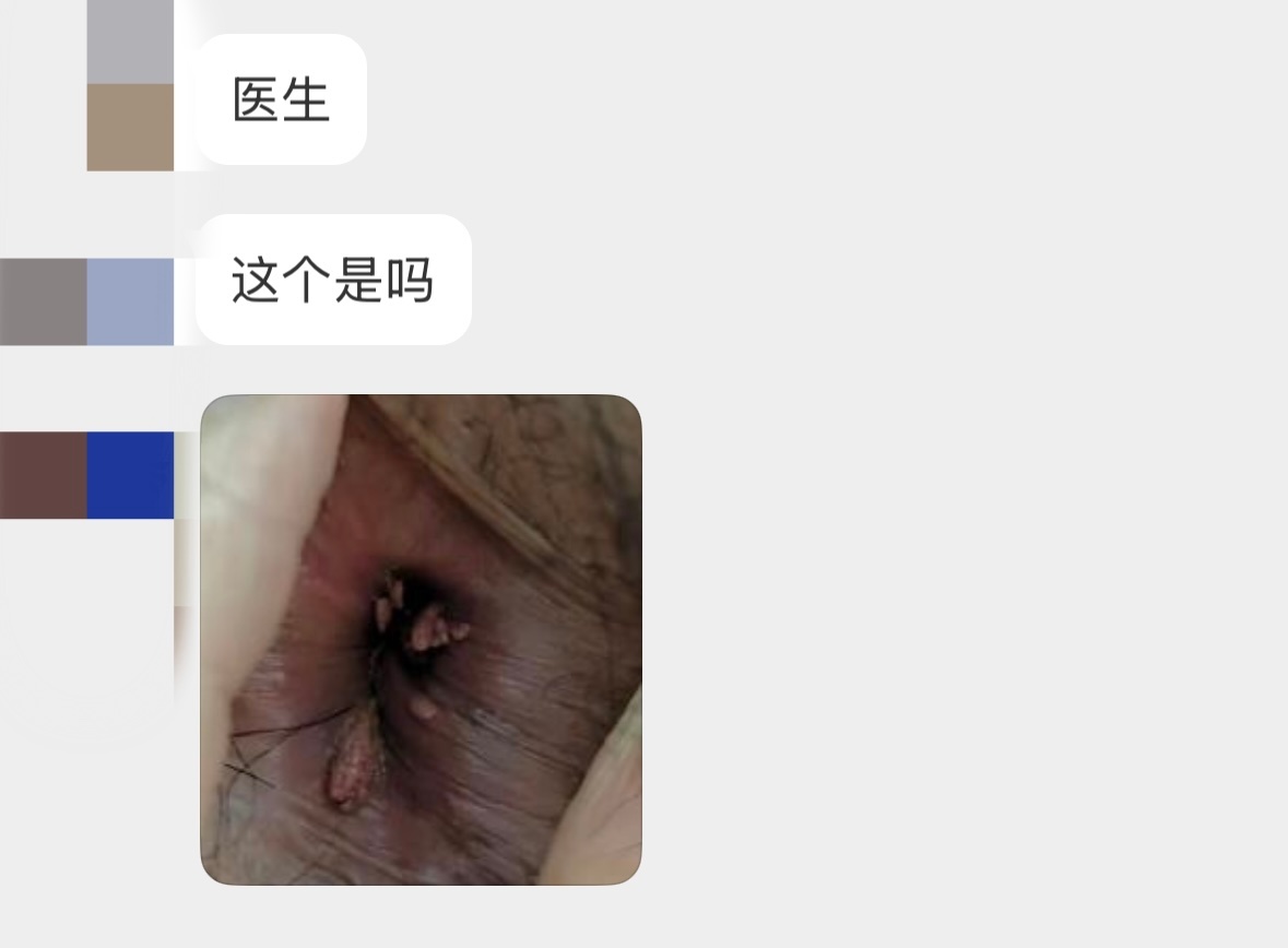 如何判斷得了肛門疣——癥狀、診斷與應對策略，肛門疣的癥狀、診斷及應對策略指南