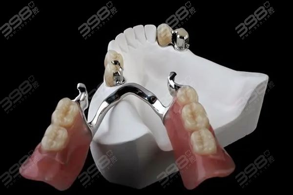 鑲一顆牙大概需要多少錢——全面解析鑲牙費用因素，鑲一顆牙的費用解析，全面探討鑲牙費用因素及大概價格