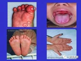 手足口病癥狀詳解，了解、預(yù)防與治療，手足口病癥狀詳解，了解、預(yù)防與治療措施