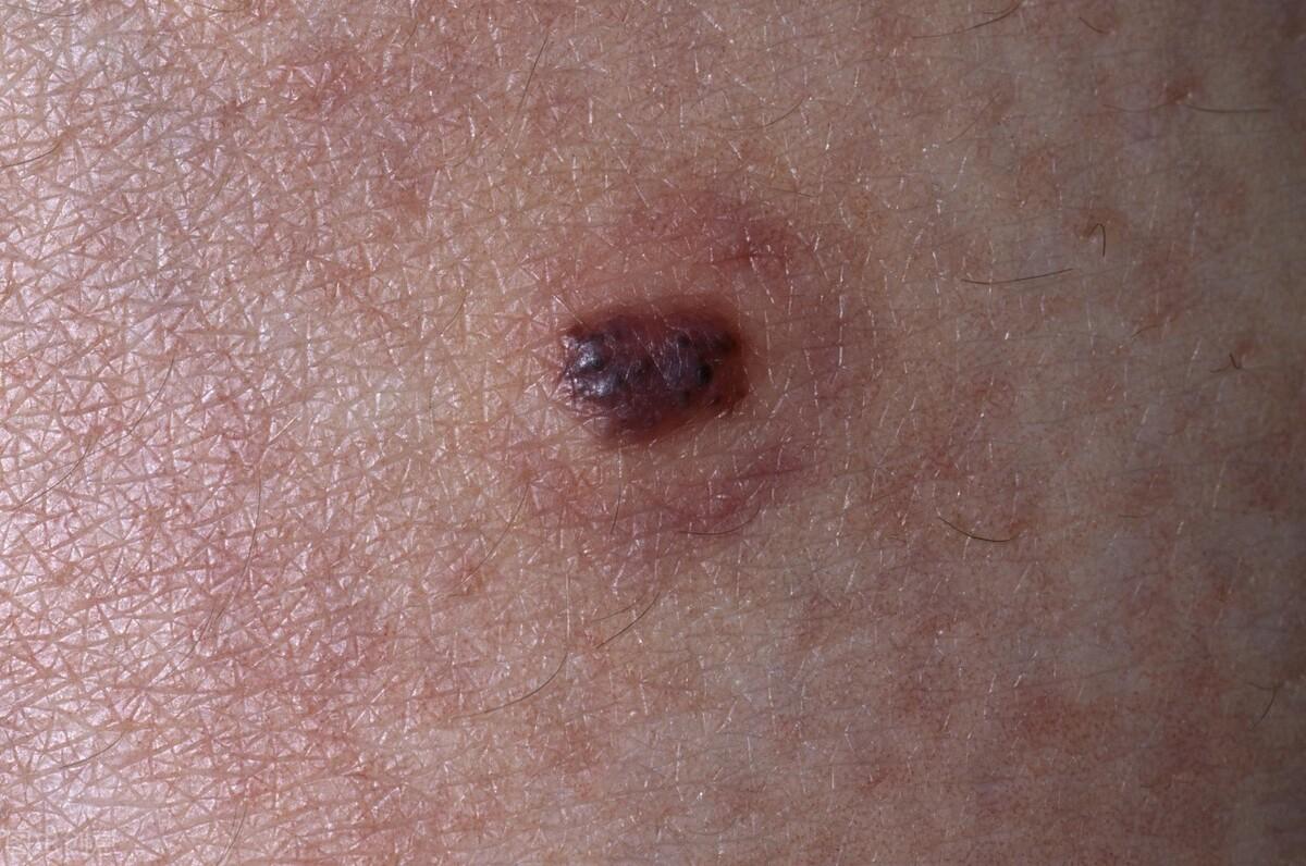 血痣和紅痣的區(qū)別圖片，深入了解兩種皮膚狀況，血痣與紅痣的區(qū)別詳解，專業(yè)圖片解析，深入了解兩種皮膚狀況特征