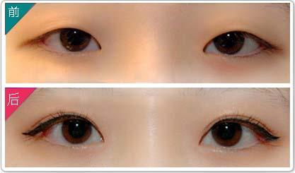 割雙眼皮多少錢呢？全面解析雙眼皮手術(shù)費(fèi)用因素，雙眼皮手術(shù)費(fèi)用全面解析，了解割雙眼皮的價(jià)格與影響因素