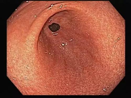 淺表性胃炎的癥狀及其影響，了解、預(yù)防與治療，淺表性胃炎的癥狀、影響、預(yù)防與治療全解析