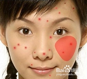 青春期長痘痘了怎么消除，全面解析與應(yīng)對方法，青春期痘痘消除全面解析與應(yīng)對方法指南