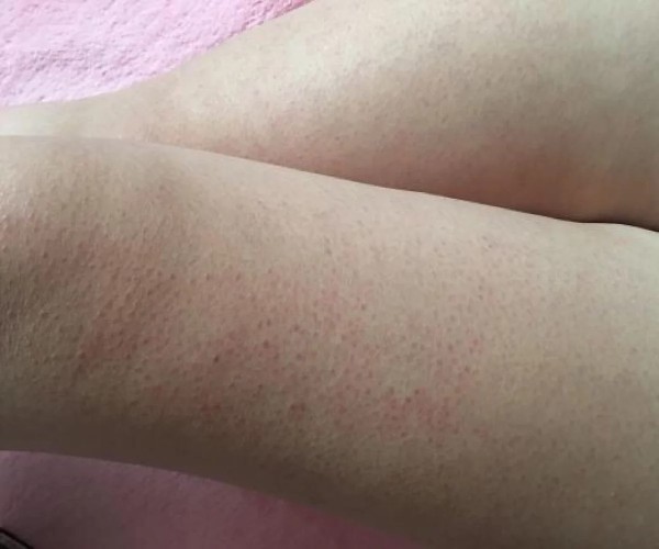 去除雞皮膚的小妙招，讓你的肌膚煥發(fā)自然光彩，雞皮膚改善秘訣，輕松告別不光滑，肌膚煥發(fā)自然光彩小妙招