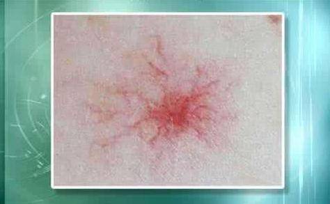 肝癌身上出現(xiàn)紅點(diǎn)圖片，癥狀解析與關(guān)注，肝癌身上紅點(diǎn)解析，癥狀、圖片及關(guān)注重點(diǎn)