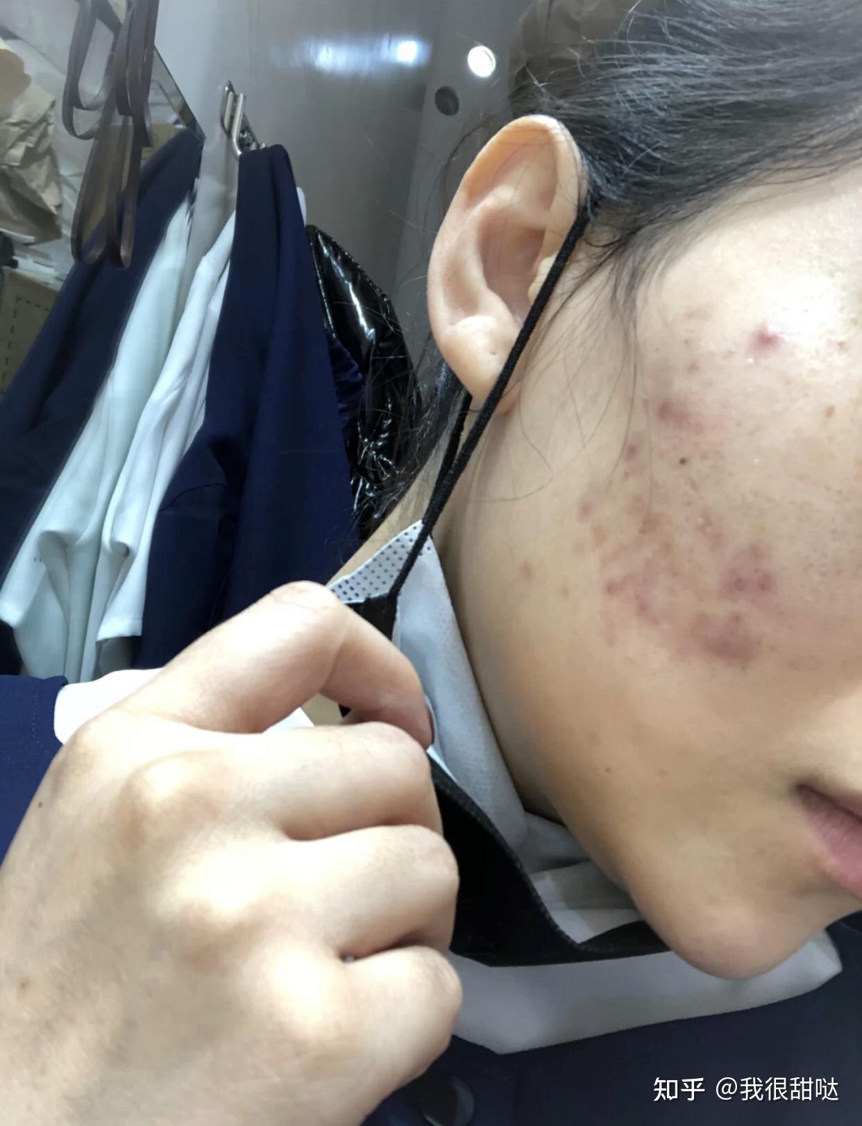 怎樣去除青春痘及痘印，全面解析有效方法，全面解析，青春痘與痘印的去除有效方法