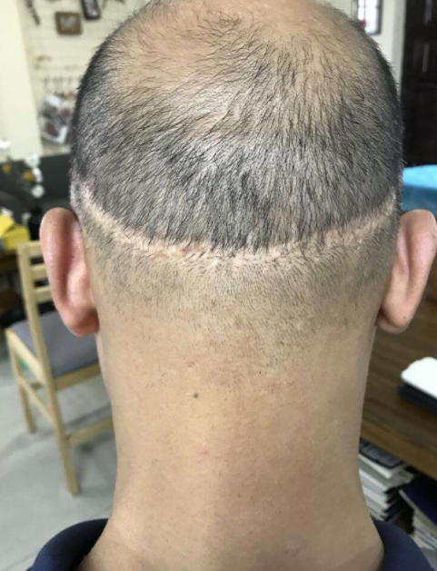 植發(fā)效果的持久性，能否長(zhǎng)期維持與多種因素相關(guān)，植發(fā)效果的持久性與多種因素關(guān)聯(lián)，長(zhǎng)期維持探討